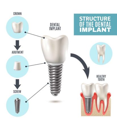 Dental Implant Structure and Costs