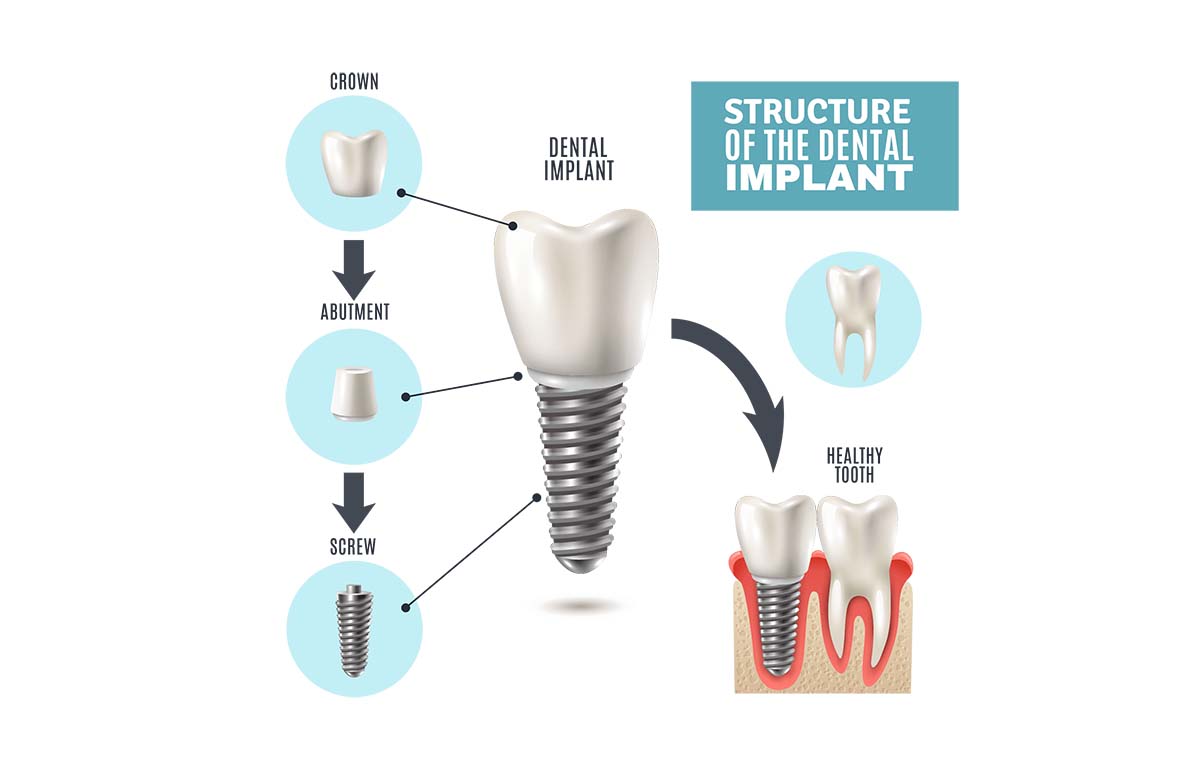 Dental Implant Structure and Costs