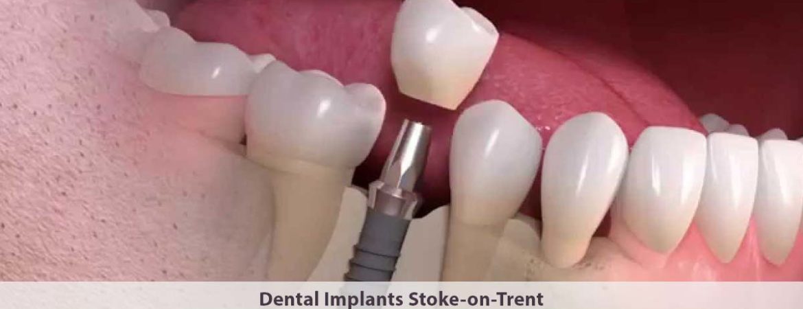 Dental Implants Stoke-on-Trent