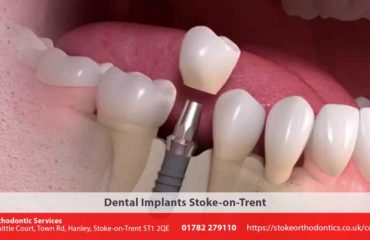 Dental Implants Stoke-on-Trent